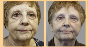 before and after Exilis