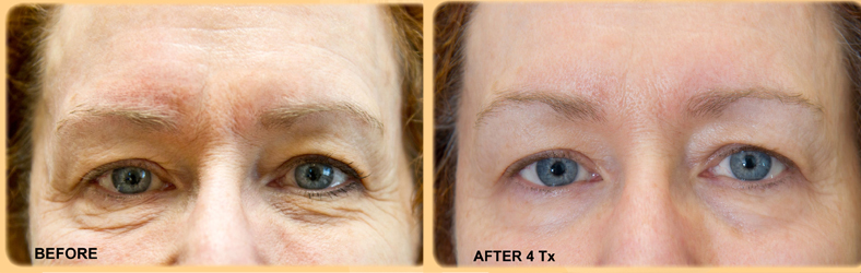exilis-eyes-before-after