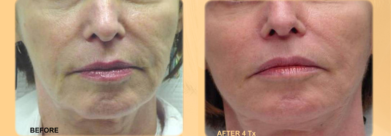 exilis-lower-face-dr-radin