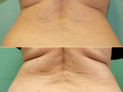 before after skin tightening