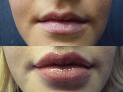 before after lip filler