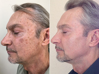 before after brown spots on skin