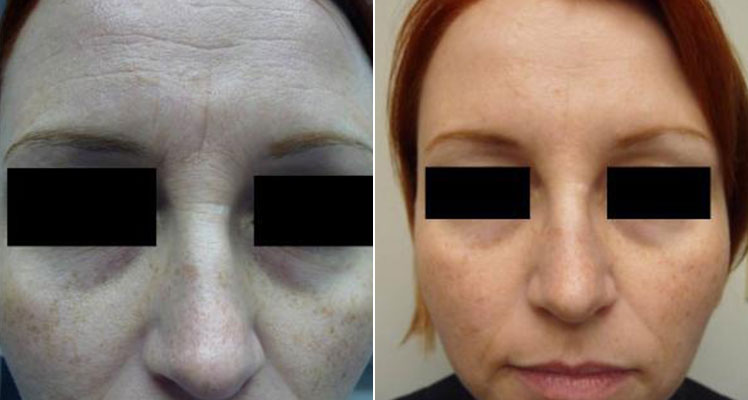before and after botox red haired woman