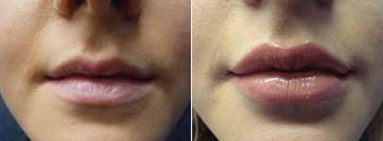 before and after filler on lips