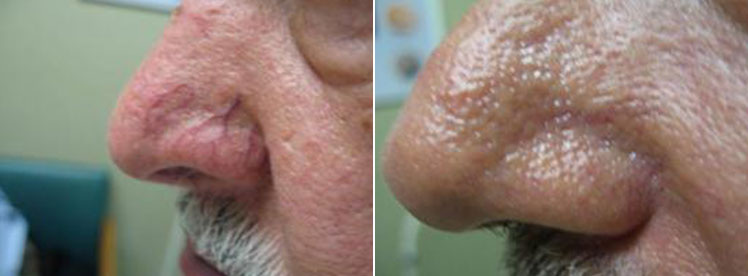 before and after blood vessels on nose