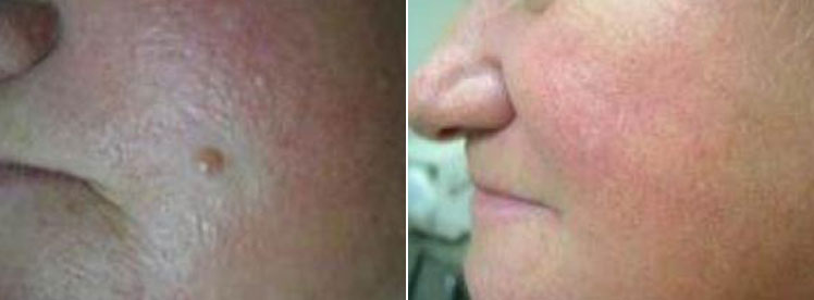before and after mole removal young woman