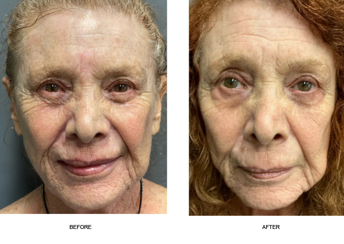 halo resurfaacing woman