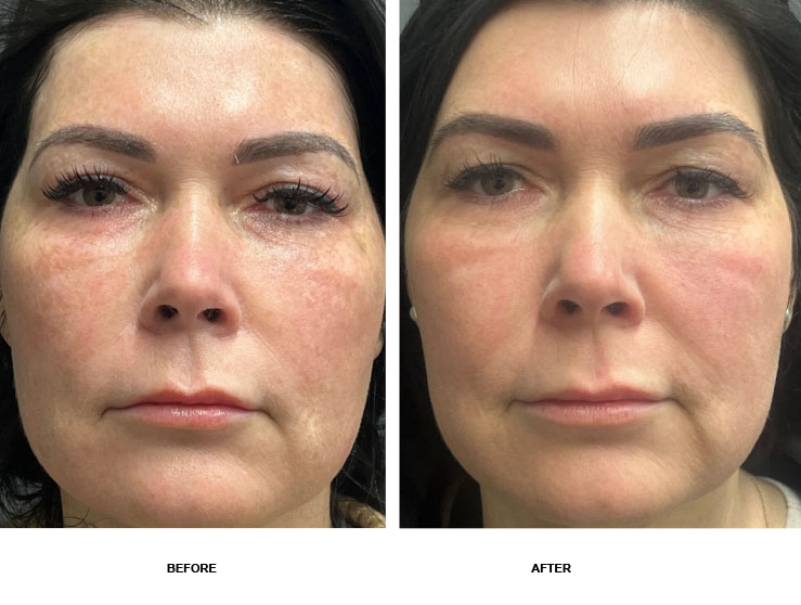 halo resurfacing woman