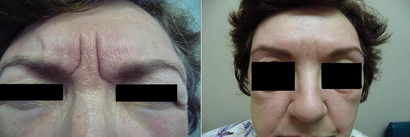 Botox before & after 1
