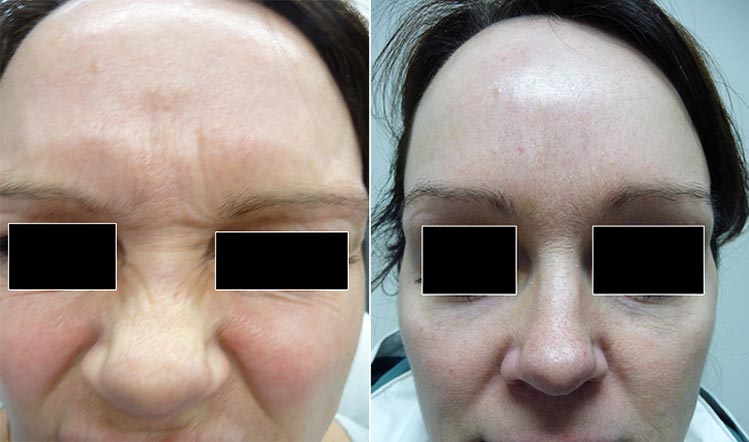 Botox before & after 2