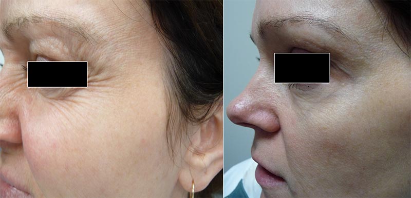 Botox before & after 4