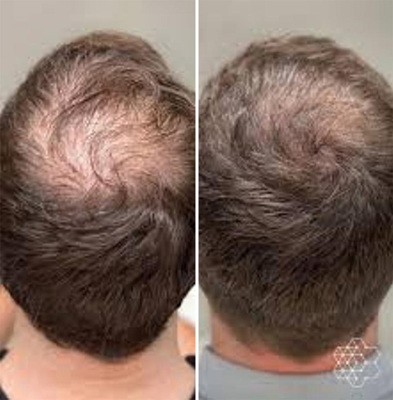 PRP Treatment on male