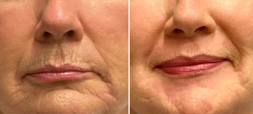 woman with lip filler