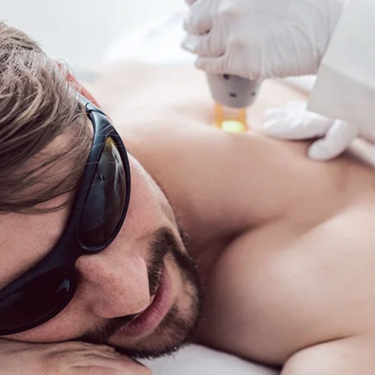 mock-laser-treatment-01