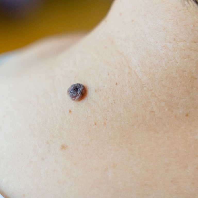 mole removal service