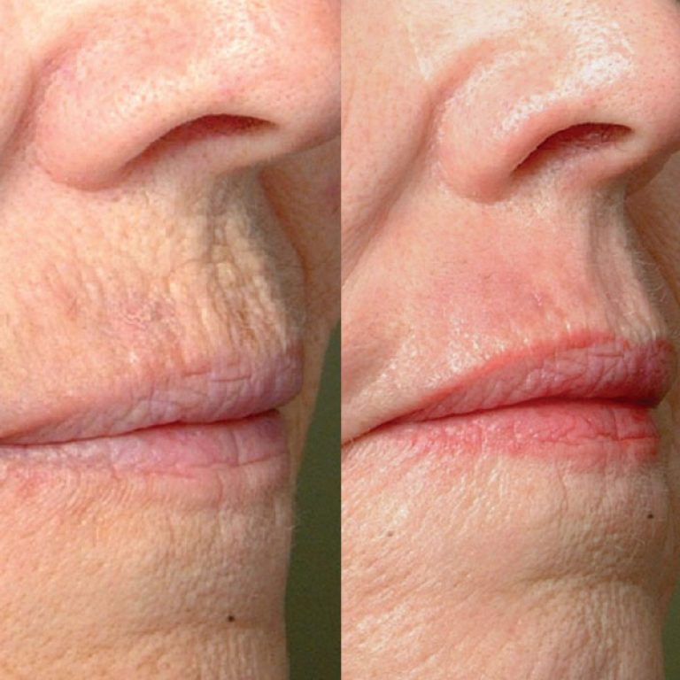 micropeel