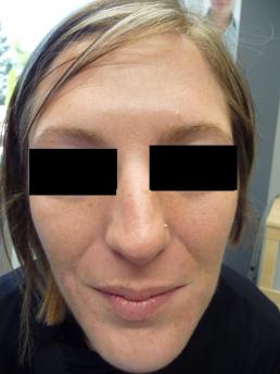 botox-windsor