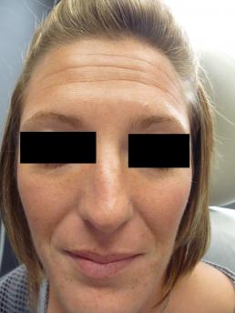 botox-windsor