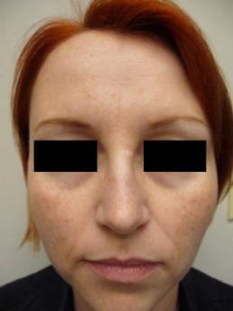 botox-windsor