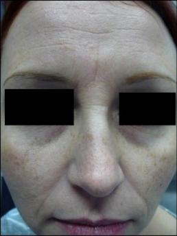 botox-windsor