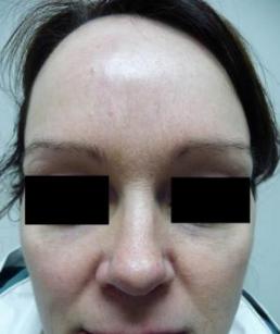 botox-windsor