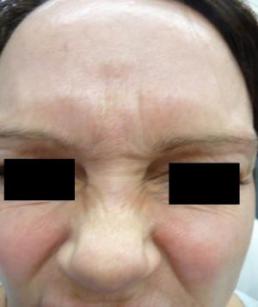 botox-windsor