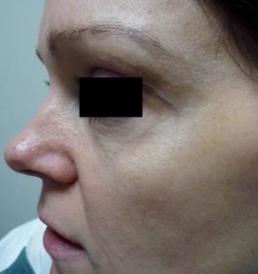 botox-windsor