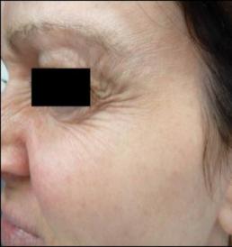 botox-windsor