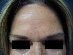 botox-windsor