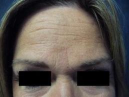 botox-windsor