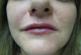 lips-windsor