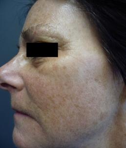 halo-resurfacing-laser-windsor