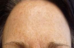 halo-resurfacing-laser-windsor