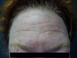 halo-resurfacing-laser-windsor