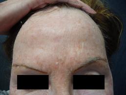 laser-resurfacing-windsor