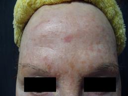 laser-resurfacing-windsor
