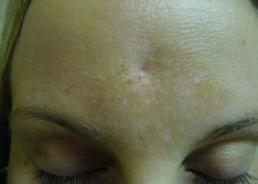 scar-removal-windsor