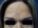 botox-windsor