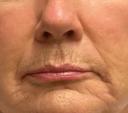 laser-resurfacing-windsor